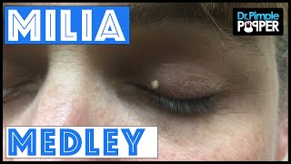 A Dr Pimple Popper Milia Medley [upl. by Airretnahs]