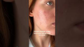 Riktig hud utan filter🥰☁️commonclouds realskin riktighud aknebenägenhud acne akne finnar [upl. by Tedra]