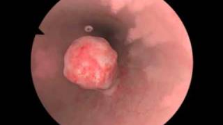 Polypectomy  Polyp Removal  New Features for Virtual Reality Surgical Simulation [upl. by Alica]