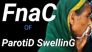 FNAC Of Parotid gland Swelling।। [upl. by Ackley]