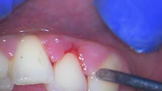 Ultrasonic teeth cleaning watch why your gums bleed [upl. by Marka]