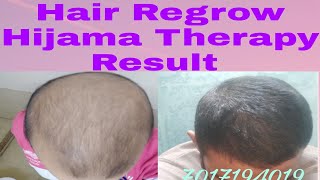 Hijama Therapy Hair Treatment Result Before After [upl. by Kayley]