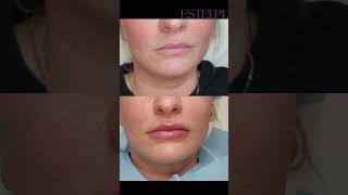 Usta powiększanie 👄 Esteipl aesthetic aestheticmedicine medycynaestetyczna [upl. by Stefano152]