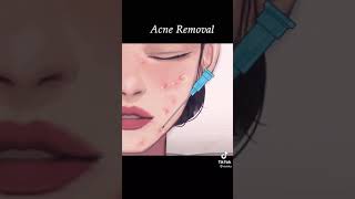 Acne [upl. by Ahsil]