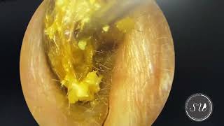 Earwax extraction by Dr Uluyol  Kulak kiri temizliği [upl. by Pani]