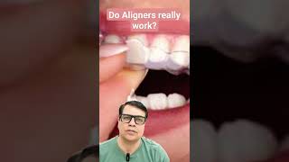 Do Aligners Really work youtubeshorts shortvideo shorts short teeth braces aligners [upl. by Anul]