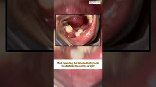 Cystic Lesion  ManDent  Children Dental Clinic [upl. by Hiamerej56]