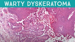 Warty Dyskeratoma acantholytic dyskeratosis patterndermatology pathology dermatopathology [upl. by Arres]