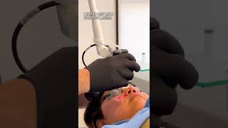 THIS Is How You Treat ACNE SCARS on Darker Skin 🙌 TCA CO2 Laser Erbium Laser Sculptra [upl. by Aicirtal68]