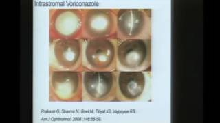 Innovations in Fungal Keratitis [upl. by Yelloh]