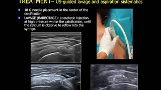 echoguided lavage of the calcific tendinitis of the shoulder [upl. by Pelagia303]