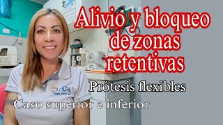 Alivio y bloqueo de zonas retentivas para prótesis flexible [upl. by Trebron797]