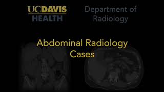 Hepatic steatosis MRI [upl. by Notsur]