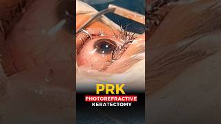 Live Photorefractive Keratectomy PRK Surgery [upl. by Norab]