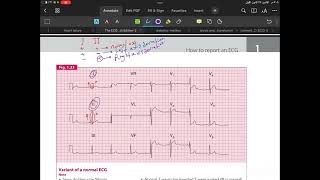 Cardiac axis deviation 🖤 [upl. by Rodmann251]