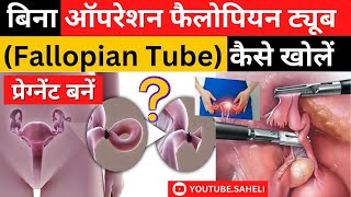 बिना ऑपरेशन फैलोपियन ट्यूब Open Fallopian Tube कैसे खोलें  EP5  SSG vs HSG Test [upl. by Paderna906]