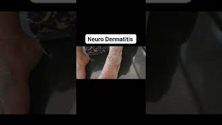 Lichen Simplex ChronicusNeuro Dermatitis dermatologist dr Bhutada Skin India [upl. by Anazraf]