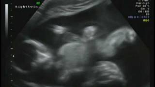 20 Week Ultrasound Identical Twins Boys [upl. by Juan]