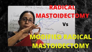 070Radical Mastoidectomy Vs Modified Radical Mastoidectomy mastoidoperations surgeryeducation [upl. by Lipps660]