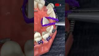 ¡Combinación de fuerzas entre BRACKETS botones y cadenas [upl. by Noemi]