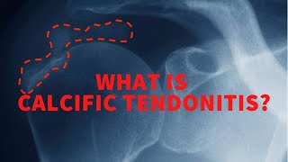 What is calcific tendonitis [upl. by Nosneh]