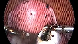 Chocolate cyst endometriosis cyst [upl. by Aizti]