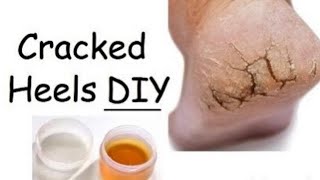 DIY Foot Cream for Dry and Cracked Heels  Overnight Result with Easy Tips [upl. by Aela]