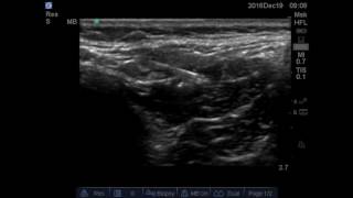 Quadratus lumborum 2 block [upl. by Anolla]