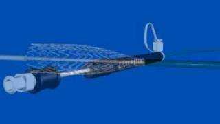 Zilver Vascular Stent [upl. by Akehsyt]