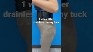 Drainless Tummy Tuck Recovery  1 week after surgery [upl. by Eelir518]