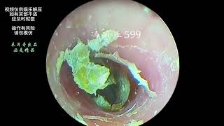 Hard cerumen removal dry pieces on the ear canal and eardrum [upl. by Eniamert]