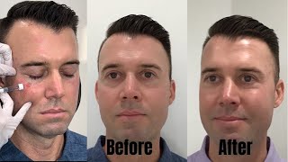 How to get rid of under eye darkness Under eye restoration with fillers [upl. by Nodab681]