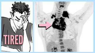 LYMPHOMA After Ignoring 6 WARNING Signs [upl. by Travus]