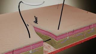 Suture Techniques  Horizontal Mattress UShaped Suture [upl. by Herculie]