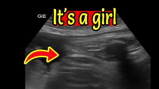 Ultrasound Showing Baby Girl [upl. by Llenaj362]