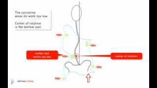 scoliosis brace management side shift  ortholutions rigo system cheneau [upl. by Assenov]