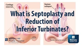 What is Septoplasty and reduction of Inferior Turbinates [upl. by Llehcram]