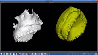 Full Edentulous Case BSB Planning in Russian [upl. by Iturhs]