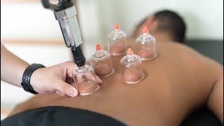 Hijama ke Fayde  Cupping Therapy  Scientific Benefits Of Hijama  हिजामा के फायदे [upl. by Featherstone]