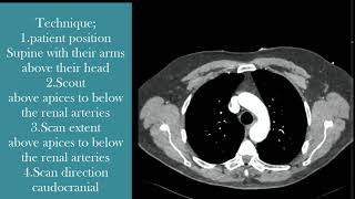 CT angiography of the chest technique [upl. by Amato]