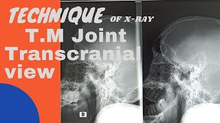 Technique of T M joints Transcranial views Ep47 Xray TM Trans cranial view position  tutorial [upl. by Ellehcram]