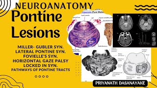 Neuroanatomy of Pons with Pontine Lesions [upl. by Newsom]