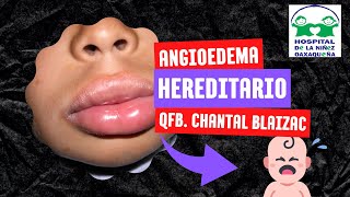 ANGIOEDEMA HEREDITARIO [upl. by Anitnegra207]