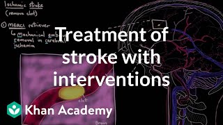 Treatment of stroke with interventions  Circulatory System and Disease  NCLEXRN  Khan Academy [upl. by Aihsemak932]