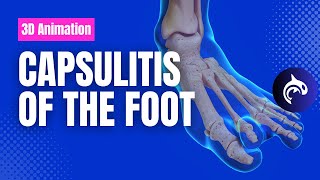 Capsulitis  Pain in the Ball of the Foot [upl. by Atnas]