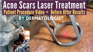 Acne Scars Laser Treatment  CO2 Laser Treatment For Acne Scars  Dermatologist  Dr Sunil Kothiwala [upl. by Mehalek503]