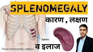 Splenomegaly  तिल्ली बढ़ना  Enlarged Spleen in Hindi  Spleen Enlargement Homeopathic Treatment [upl. by Moretta295]