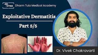 Dermatitis  Exfoliative Dermatitis Hindi  Types  Part 55 Eczema  Skin Disease  Skin Infection [upl. by Asaret]