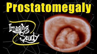 Prostatomegaly  Enlarged Prostate  Ultrasound  Case 118 [upl. by Georgia381]