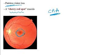 Video 219 Common Refractive Errors amp Retinal Pathologies Clinical Presentations amp Diagnosis [upl. by Brander]